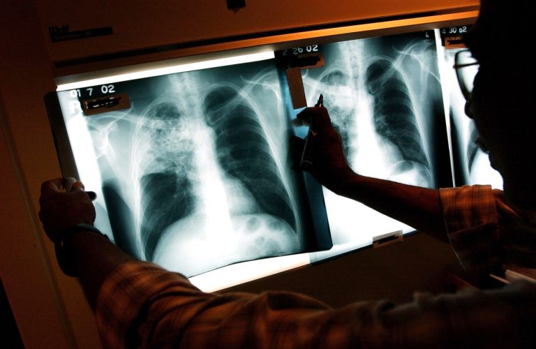 Tuberculosis cases continue to increase in Southern California